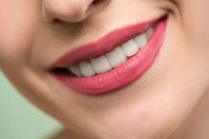 merrylands-dental-veneers-smile