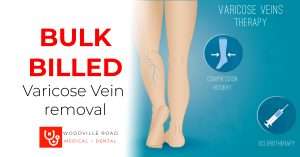 Varicose vein bulk billed removal